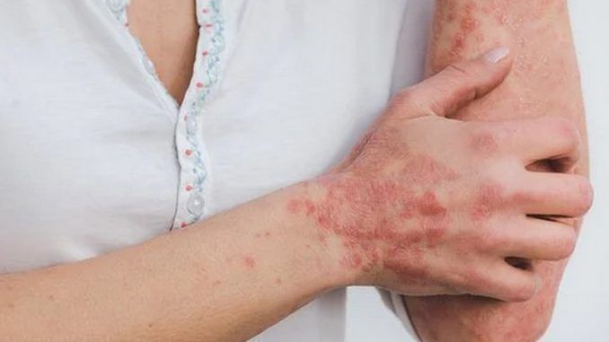 Psoriasis to cure c it is also the platform with l app